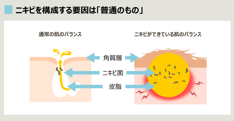 ニキビ肌と健康な肌